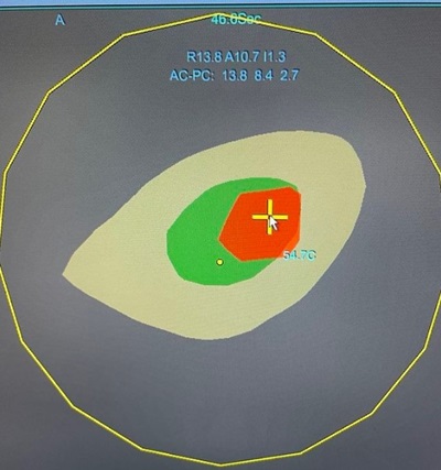 Heat Map from Focused Ultrasound